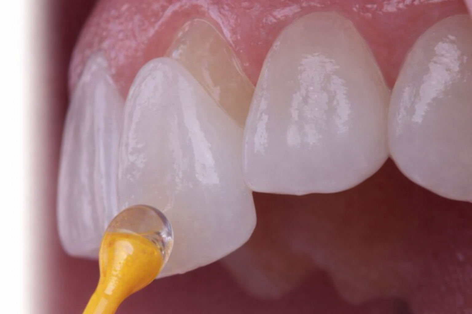 라미네이트 크라운 앞니 치료 연세원드림치과