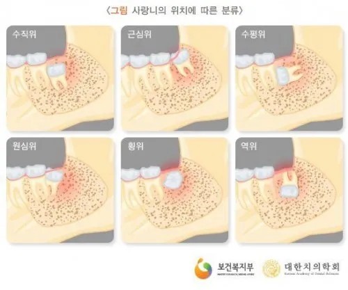 광진구 연세원드림치과 사랑니 맹출 유형