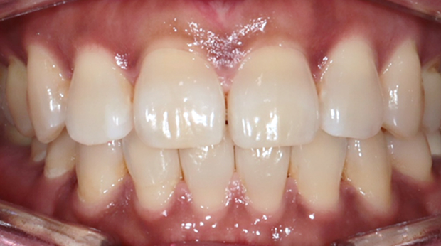 사랑니 발치 후