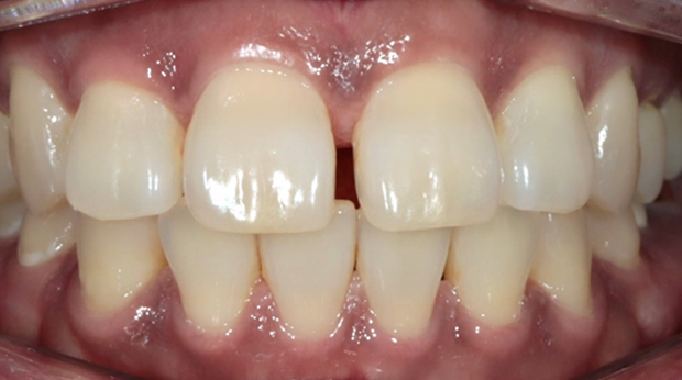 사랑니 발치 전