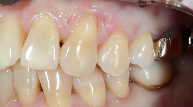 사랑니 발치 후