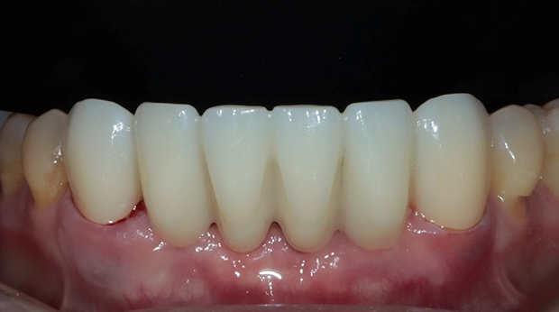 사랑니 발치 후