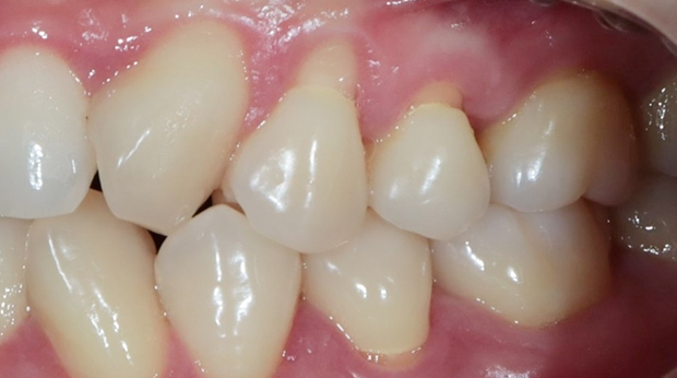 사랑니 발치 전