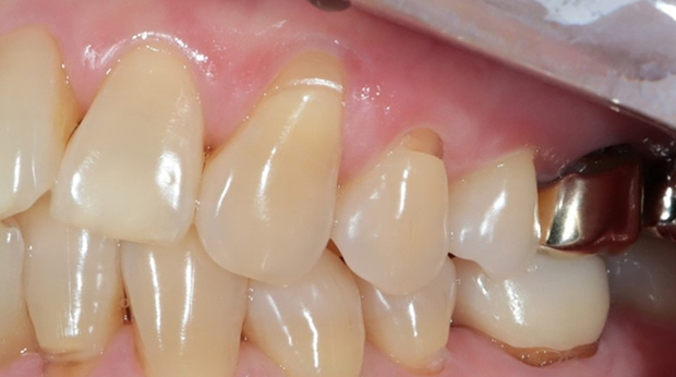 사랑니 발치 전