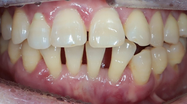 사랑니 발치 전