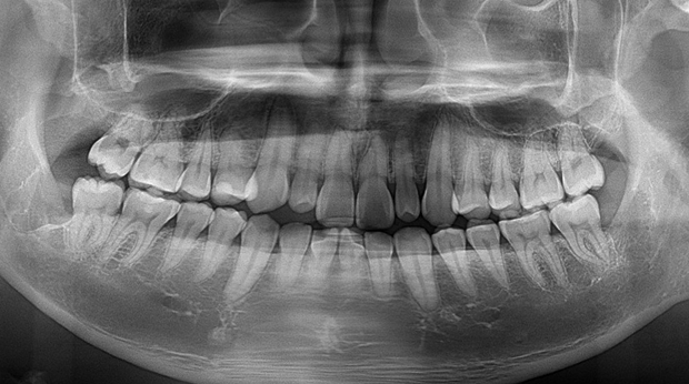 사랑니 발치 후