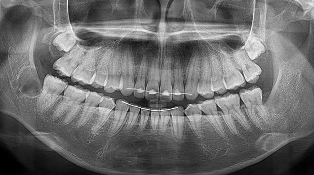 사랑니 발치 후