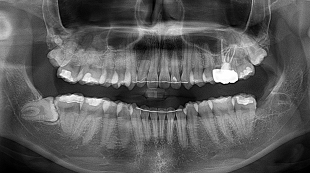 사랑니 발치 후