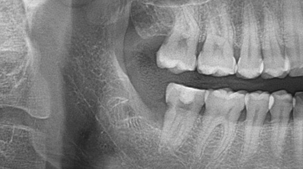 사랑니 발치 후