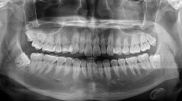 사랑니 발치 전