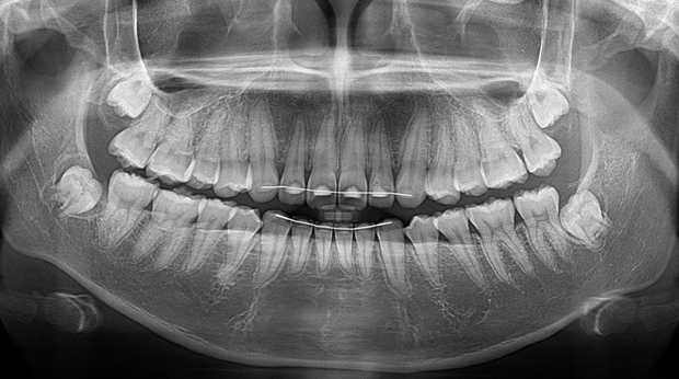 사랑니 발치 전