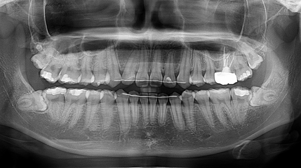 사랑니 발치 전