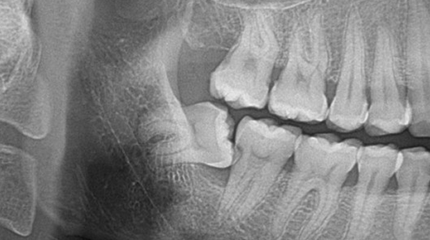사랑니 발치 전